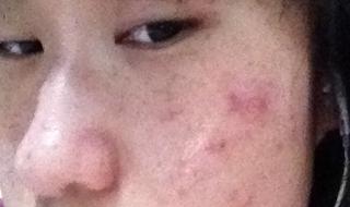 额头长痘痘了怎么办 额头长痘痘了怎么办